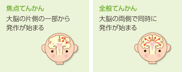 てんかん 悪化 _ てんかん 原因 わかり やすい – LXCM